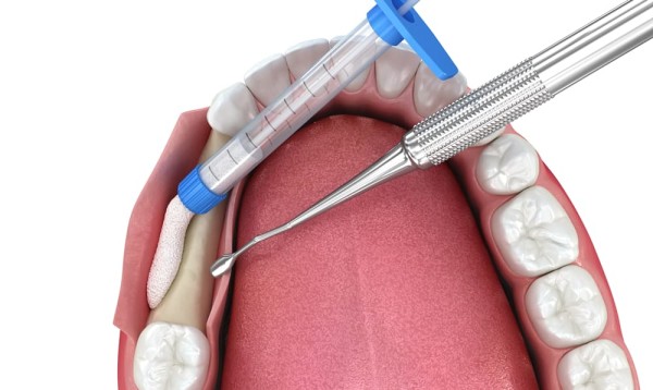 연신내역치과추천 뼈이식 필요 여부로 보는 임플란트 가능성 판단